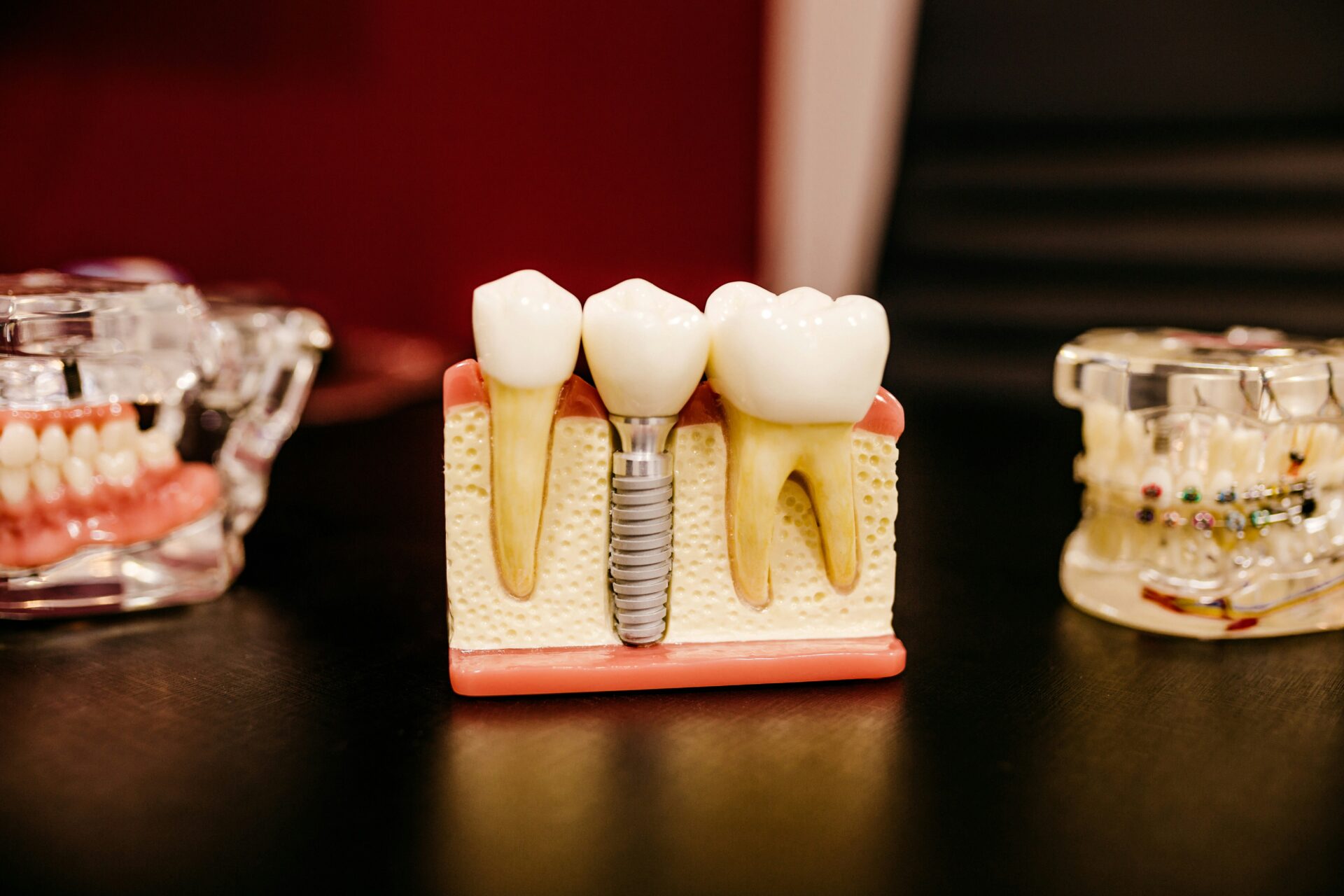 How Long Do Dental Implants Last