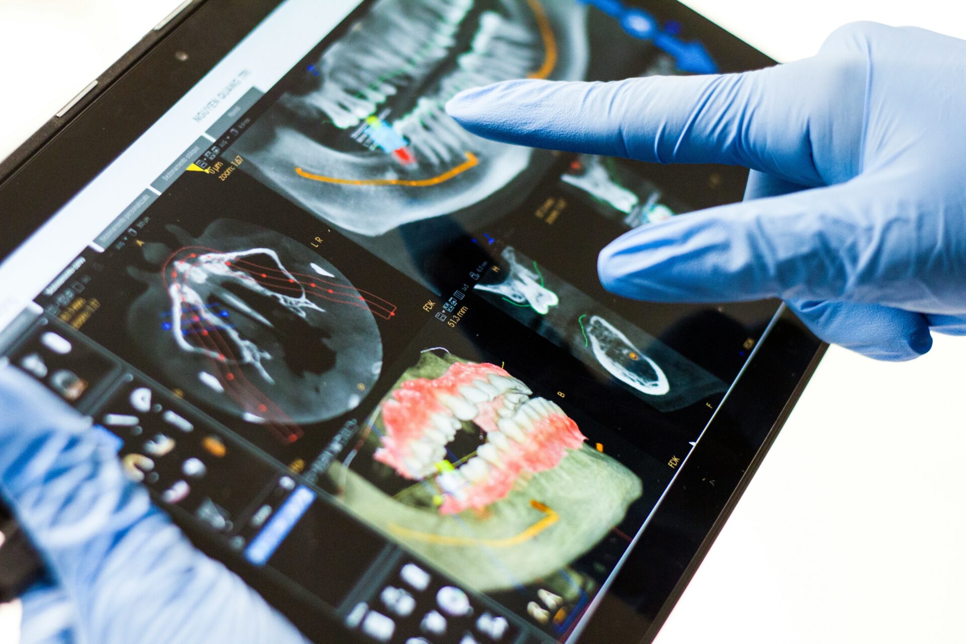 The Benefits of Dental Implants